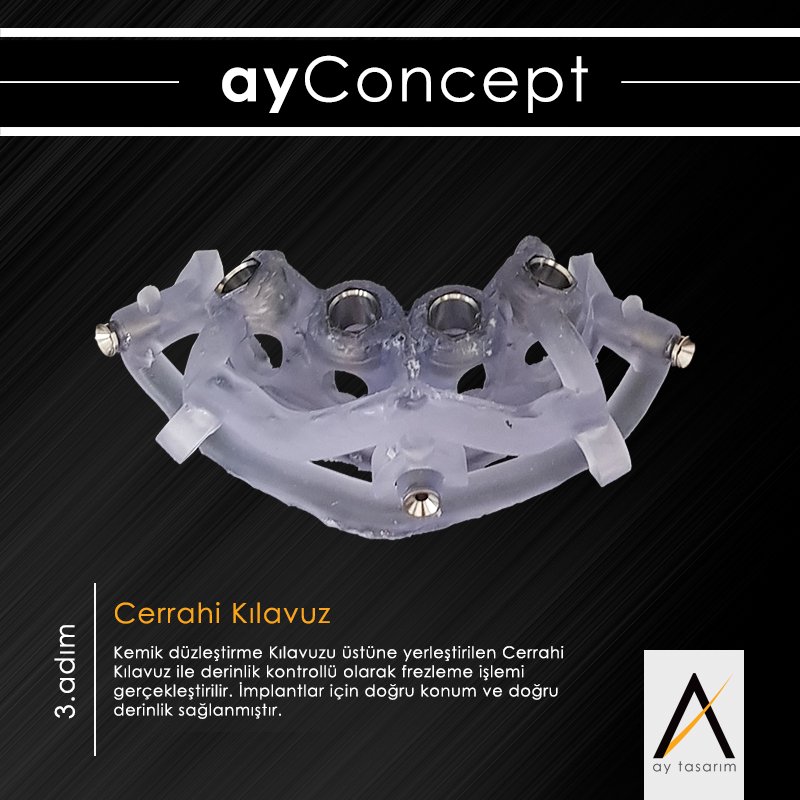 aytasarim's tweet photo. Artık implant tedavilerinizde uçtan uca, yani implantların planlanmasından, restorasyonun dikey yükseklik dikkate alınarak bitirilmesine kadar gerekli tüm aşamaları tek bir katmanlı cerrahi kılavuz sistemiyle çözebileceksiniz. https://t.co/1rUD5tEizR