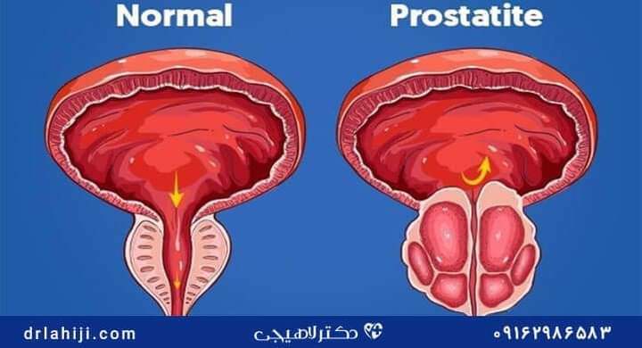 [𝗠𝗔𝗚-𝗦𝗔𝗡𝗧𝗘] 🔴 𝗟𝗘 𝗖𝗔𝗡𝗖𝗘𝗥 𝗗𝗘 𝗟𝗔 𝗣𝗥𝗢𝗦𝗧𝗔𝗧𝗘
La prostate est une glande exocrine, ovoïde, faisant partie du système reproducteur masculin qui pèse entre 15 à 25 grammes à l’âge adulte lorsqu’elle est saine. Info+👉facebook.com/espacesciences…