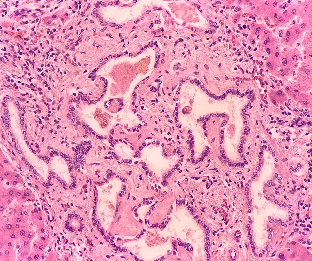 Incidental lesion in a 50-year-old male.
Site?
Diagnosis?
Or is it #TooCloseToDiagnose?

#PathTwitter #pathology #MedTwitter #HPBpath #pathboards

@atman_ci @DrGeeONE @smlungpathguy @glinglerimek @sumeyra_md @DrBMcGinn @pepeheffernan @DraEosina @JMGardnerMD @TristanRutland7