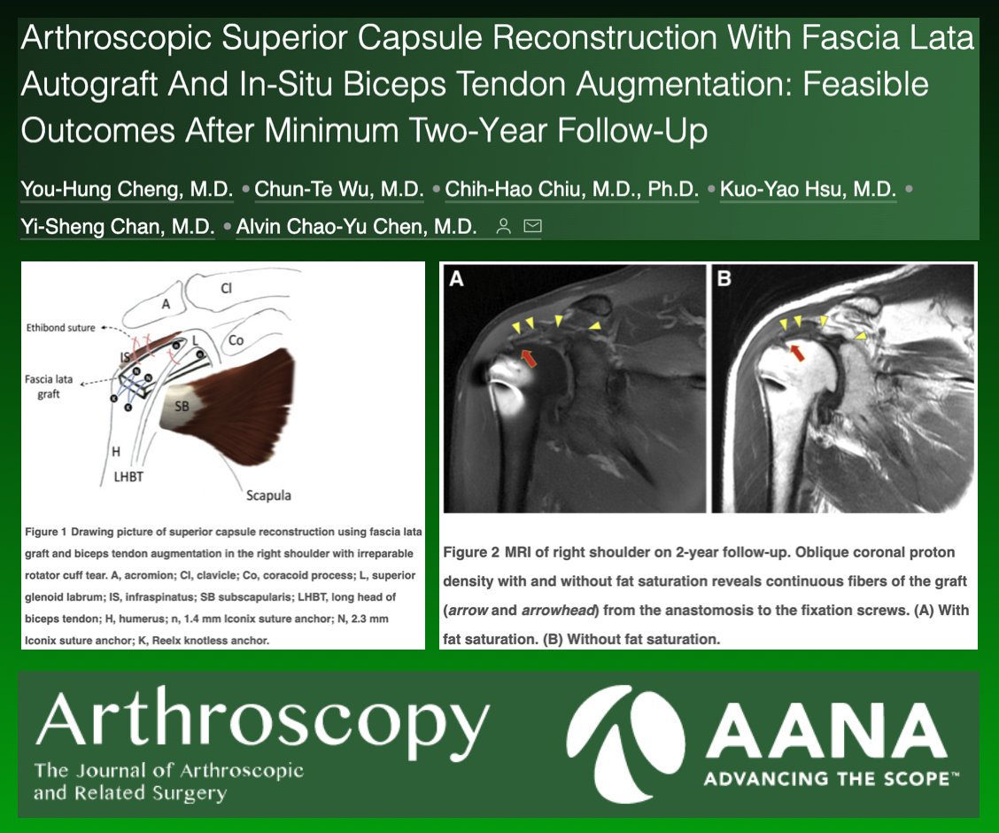 Novel technique and preliminary results in ASMR! ow.ly/b7gB50LjNY7 #shoulder #SCR #biceps #arthroscopy #AANA #rotatorcuff #surgery
