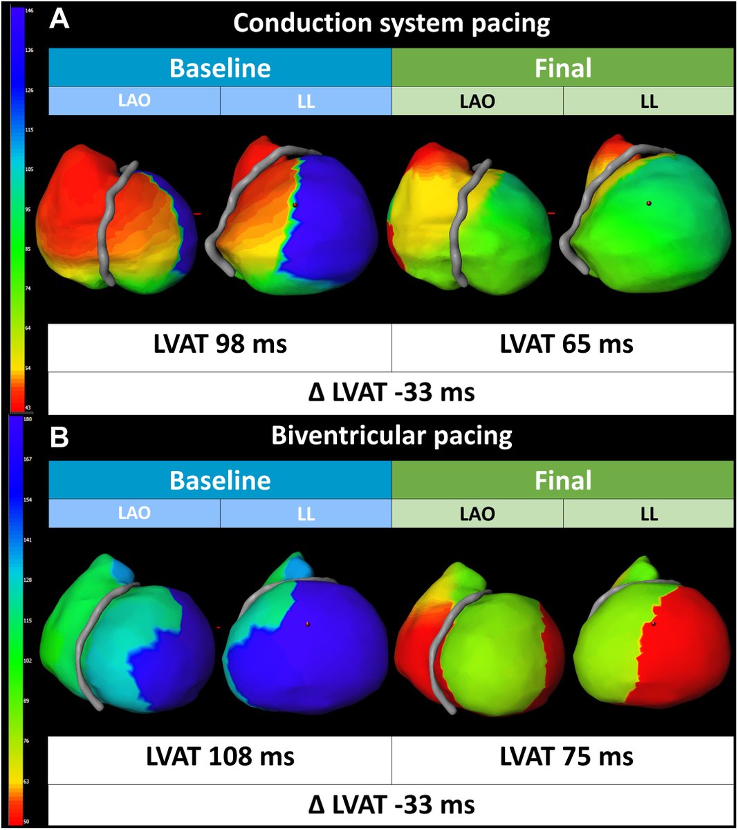 * LEVEL-AT Trial* Conduction System Pacing vs Biventricular Pacing in Heart Failure and Wide QRS Patients
CSP vs BiVP (n=70) Similar degrees of cardiac resynchronization, ventricular reverse remodeling, and clinical outcomes
@jaccjournals jacc.org/doi/10.1016/j.…