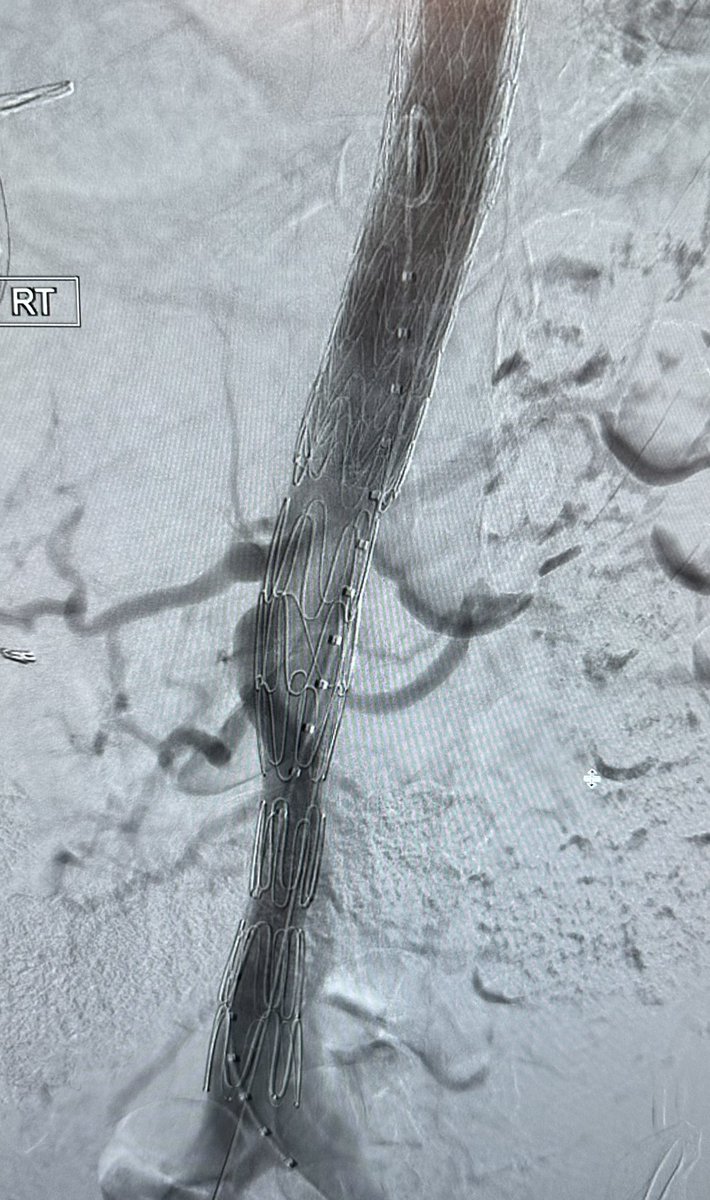 #irad, #vascsurg &amp; #CTSurg #aorta collab: Type I dsxn s/p surgical arch/root repair &amp; valve resusp w/ persistent dsxn from LSCA to bifurcation. <a href="/WLGore/">Gore</a> TBE with VBX flared at gate from wire snared from L radial + <a href="/cookvascular/">Cook Vascular</a> petticoat with excellent LSCA and visceral perfusion.