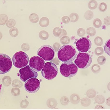 Peripheral smear with numerous myeloid blasts