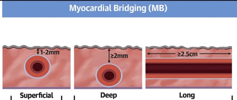 Cardiac CT Coronory Myocardial Bridging Classification. Depth . Normal (Within Epicardial Fat ) Superficial Intramyocardial (1-2 mm) Deep Intramyocardial         (>_2 mm) Very Deep Intramyocardial   (>_5mm) Length. Shorter Length .(<25mm) Longer Length .(_>25 mm)