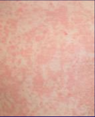 BWH_IDinPCARE's tweet photo. Test your travel medicine knowledge!

23yo woman with fever and rash 3 days after returning from vacation in Bahia, Brazil 

Fever, chills, headache, myalgia, arthralgia 
Temp 102, diffuse rash, lymphadenopathy 
WBC 3400 with normal differential, platelets 120,000 

Ddx? https://t.co/0arKKgD7wW