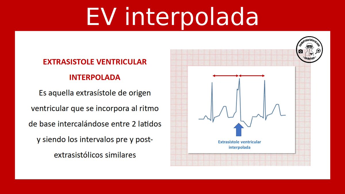 ¿Qué es una extrasístole ventricular interpolada? ¡Descúbrelo con uno de nuestros #CardioTruco!