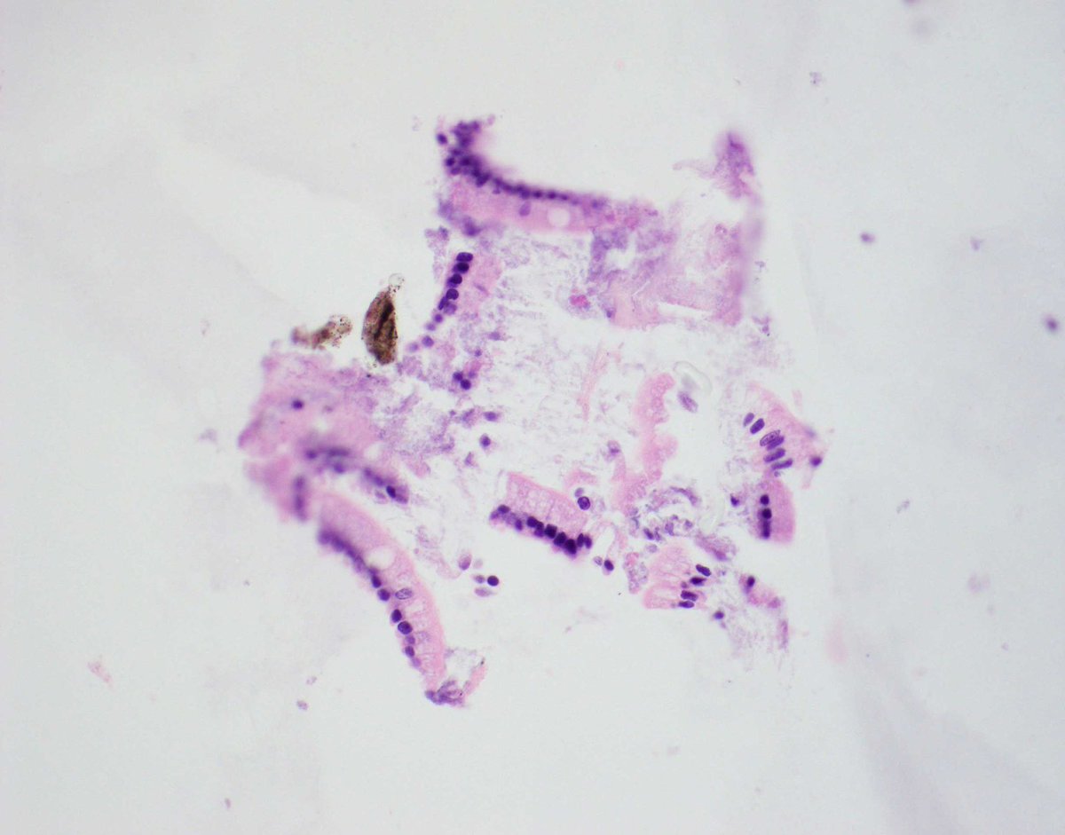 Power point was way off with the autogenerated ALT text for this image! Come see the rest of this “dessert” at the upcoming ICC-ASC pancreatobiliary symposium in Baltimore!