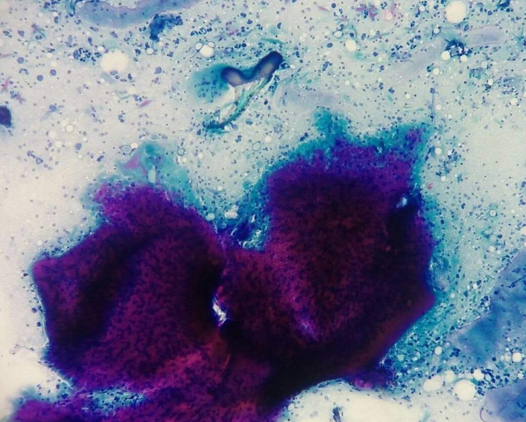 ArghyaBandyopa5's tweet photo. 32 years female, FNAC from subcutaneous nodule in neck. What is the most likely diagnosis? https://t.co/zOMD1GaCRI