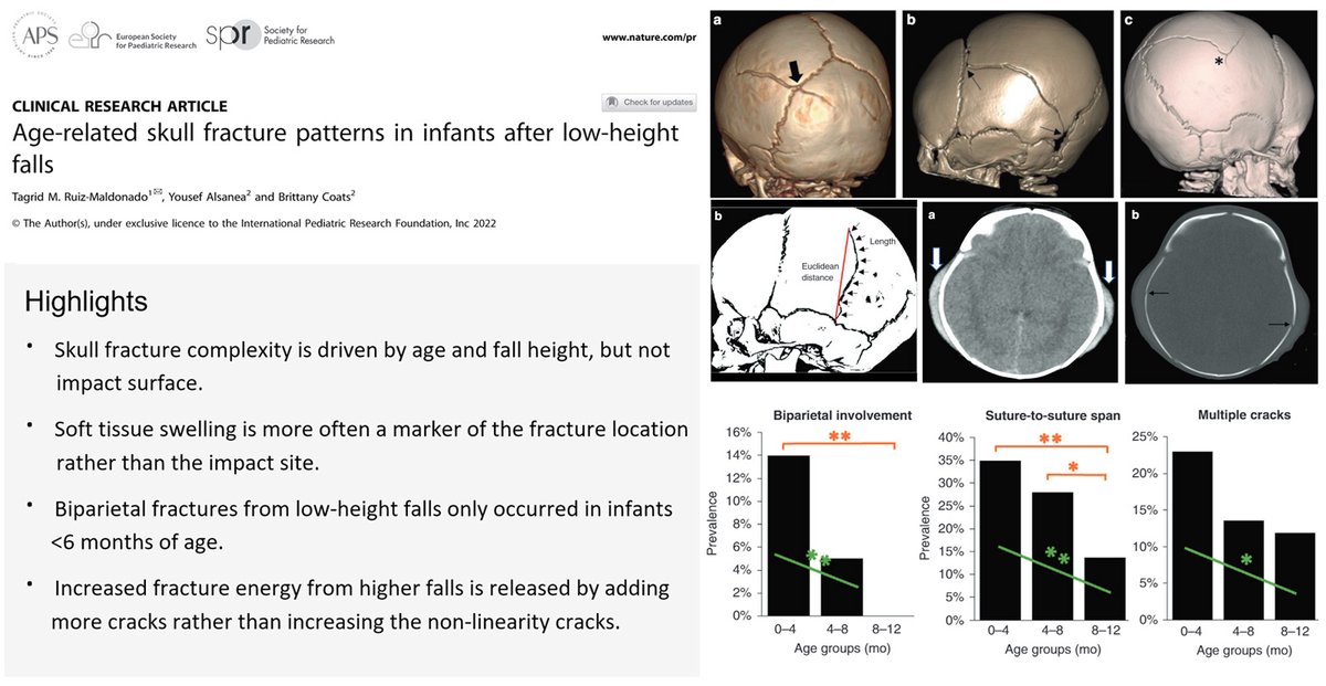 Brittany Coats (@coatsheadlab) on Twitter photo Great @UtahHeadLab collaboration with <a href="/tagridruiz/">Tagrid Ruiz-Maldonado</a>
on clinical infant skull fractures. Interesting data on complex fracture patterns in young infants. Access for free via <a href="/SpringNature/">velma james</a> using rdcu.be/cYjYB. 
<a href="/UtahMech/">UofU Mech Eng</a> <a href="/UofUPediatrics/">UofUPediatrics</a> <a href="/UofUResearch/">Research at the U</a> <a href="/UUtah/">University of Utah</a> Great @UtahHeadLab collaboration with <a href="/tagridruiz/">Tagrid Ruiz-Maldonado</a>
on clinical infant skull fractures. Interesting data on complex fracture patterns in young infants. Access for free via <a href="/SpringNature/">velma james</a> using rdcu.be/cYjYB. 
<a href="/UtahMech/">UofU Mech Eng</a> <a href="/UofUPediatrics/">UofUPediatrics</a> <a href="/UofUResearch/">Research at the U</a> <a href="/UUtah/">University of Utah</a>