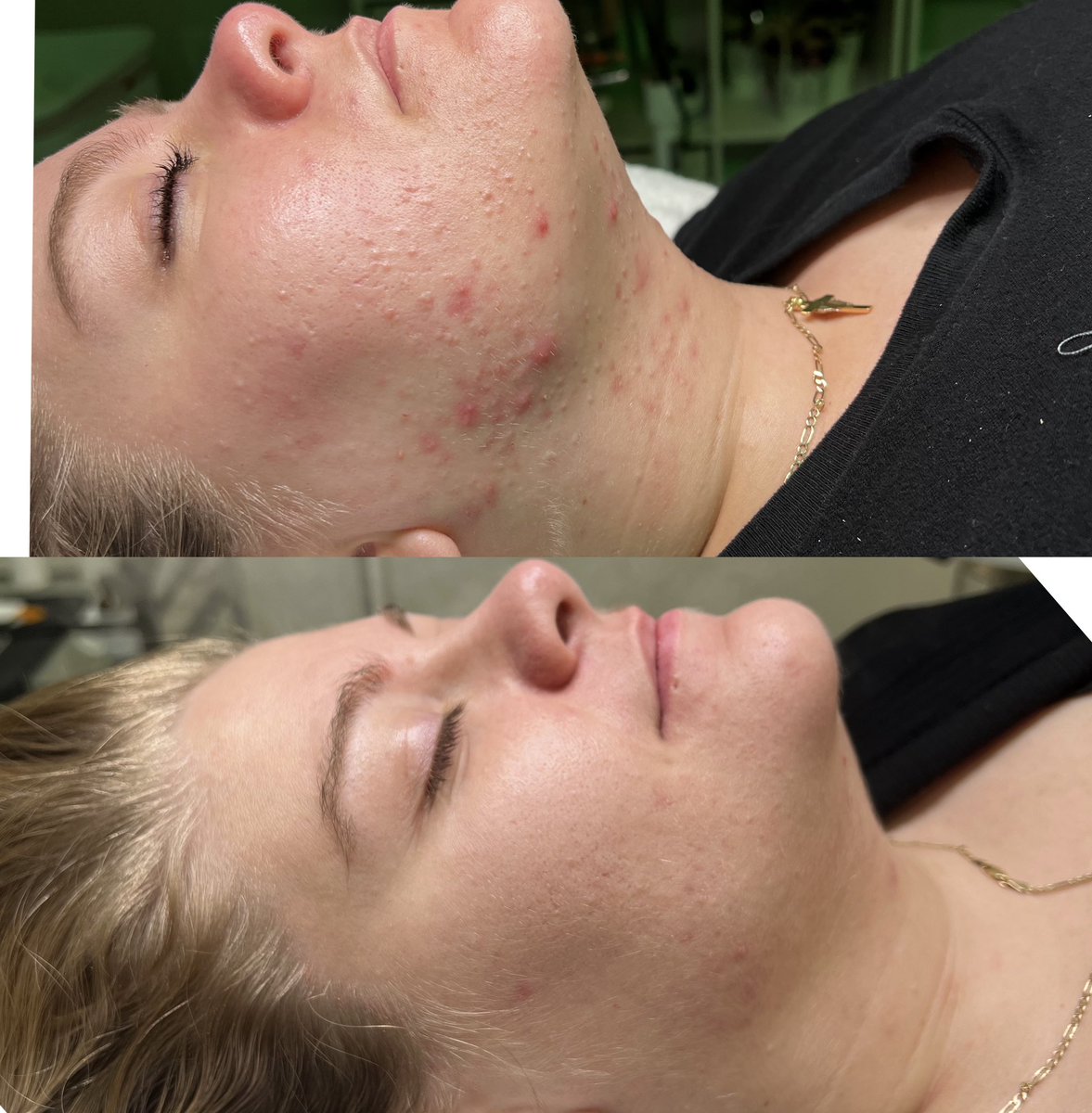 hayleytheesthi's tweet photo. my career is so rewarding 🫶🏼 check out these before &amp; afters! #phillyesthetician #phillyfacials https://t.co/osJNaShYNB