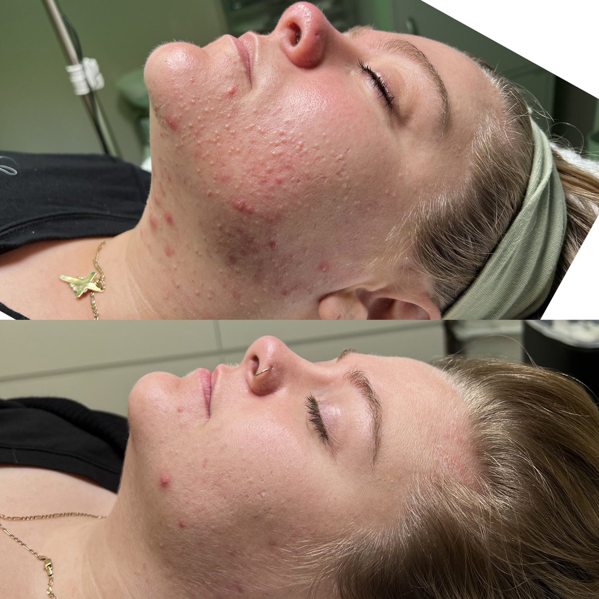 hayleytheesthi's tweet photo. my career is so rewarding 🫶🏼 check out these before &amp; afters! #phillyesthetician #phillyfacials https://t.co/osJNaShYNB