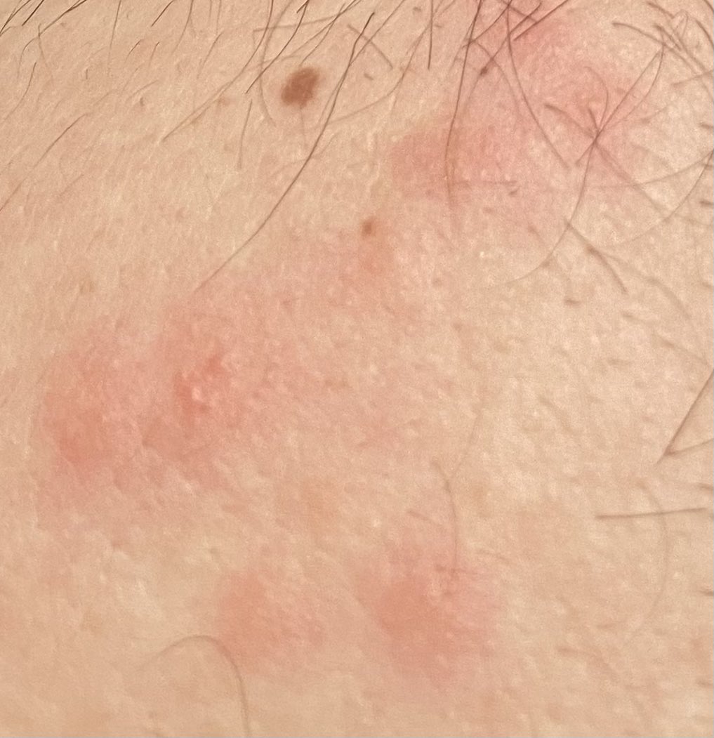 I feel drained🫥
@SusanEichhofer We regret to inform you that we have sucked every drop of blood🩸out of your husband’s body and his entire skin is now covered in itchy spots. We will roll him up &amp; send him back to you by mail
Sincerely
The ruthless Mosquito🦟 Society of Mallorca