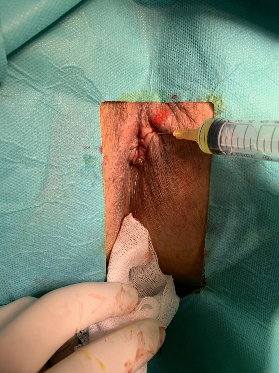 colorectalHGG's tweet photo. Tratamiento de la fistula perianal con plasma rico en factores de crecimiento con resultados prometedores🔝🔝 https://t.co/hImNQDTm1j