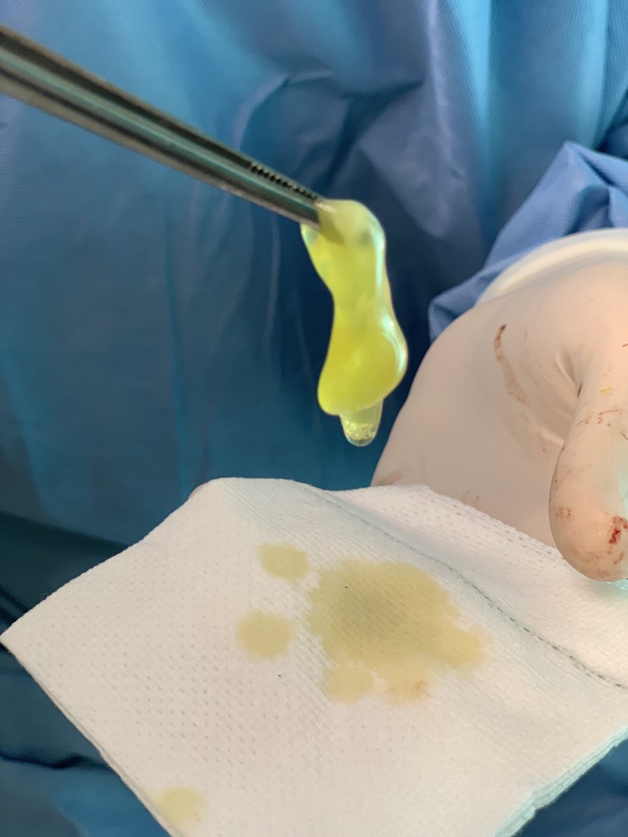 colorectalHGG's tweet photo. Tratamiento de la fistula perianal con plasma rico en factores de crecimiento con resultados prometedores🔝🔝 https://t.co/hImNQDTm1j