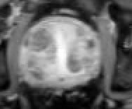 DaveJohnsonMD's tweet photo. Pre-PAE MRI and 3mo post #PAE MRI in a pt with prostate CA: gland volume reduction over 45%! Facilitating decreased toxicity when rad onc planning XRT and improving pt baseline LUTS (1/3) https://t.co/3I3lVZI5cJ