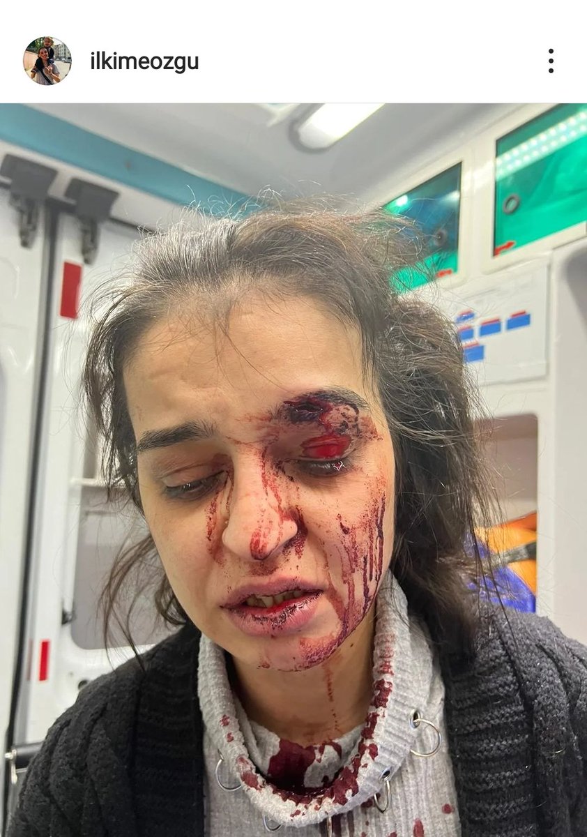 Seda44318246's tweet photo. Bir kadın daha ölmesin!
Bu kadın benim arkadaşım.
Klasikleşen hikaye...boşandığı eşi onu bu hale getirdi.
2 çocuk annesi #ilkim ölmek istemiyor!
Sen de destek ol..SUSMA
İlkim'e ses ol
#benöldüktensonragelecekadaletiistemiyorum https://t.co/yPH6p3FiOH