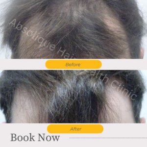 AbsoliqueHair's tweet photo. Male pattern baldness treatment – pre hair transplants - https://t.co/JzT80gcFNd https://t.co/Eg9OD4zIKZ