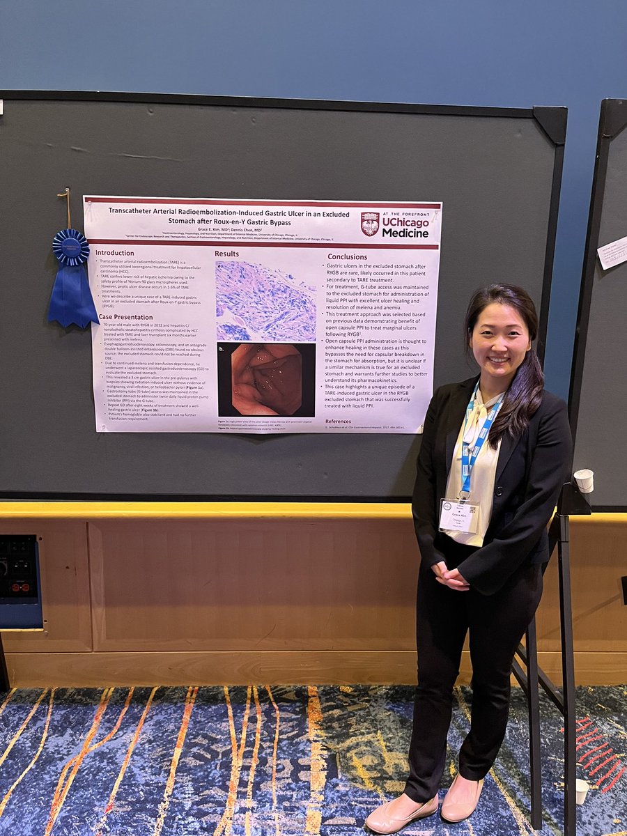 Dennis Chen (@thedennischen) on Twitter photo I’m late but super proud of our 🌟fellow Grace Kim wrapping up #ACG2022 Tues PM poster session with her🏅case of a TARE-induced ulcer in RYGB excluded stomach @UzmaSiddiquiMD <a href="/UChicagoGI/">UChicago Digestive Diseases</a> I’m late but super proud of our 🌟fellow Grace Kim wrapping up #ACG2022 Tues PM poster session with her🏅case of a TARE-induced ulcer in RYGB excluded stomach @UzmaSiddiquiMD <a href="/UChicagoGI/">UChicago Digestive Diseases</a>
