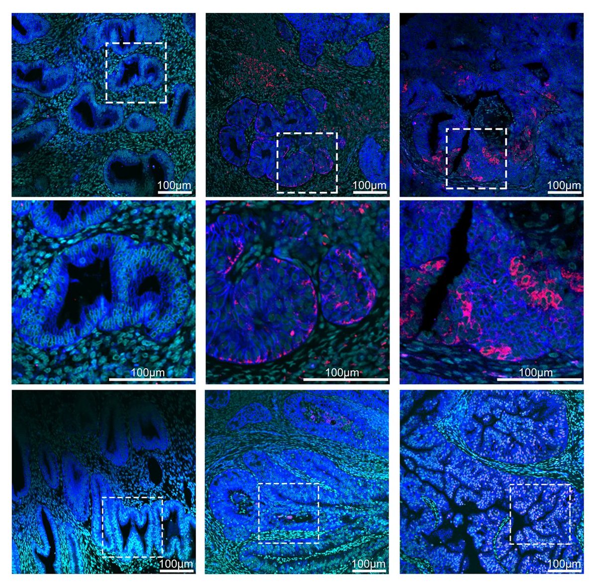 Researchers at Fudan University used #scRNAseq to profile cell atlas representing the development of endometrioid #EndometrialCancer (EEC). Published in @NatureComms, this study will facilitate the research and diagnosis of EEC. 🔎 Learn more here: go.nature.com/3DdsEq8