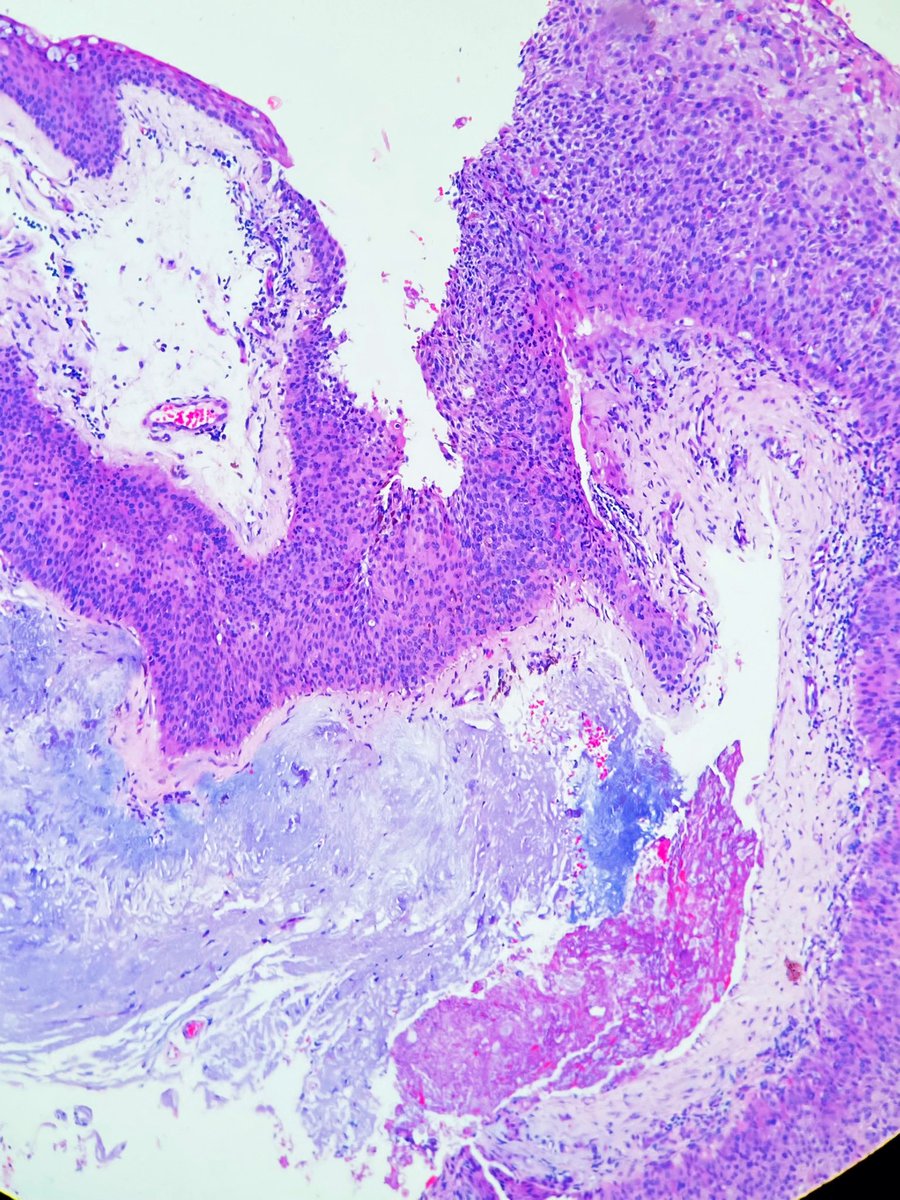 sebastianpathos's tweet image. Conjunctival intraepithelial neoplasia. Thickened epithelium (acanthosis); increased cellularity. Loss of normal maturation sequence; disorganization. Dysplasia begins in basal layers and extends toward surface. Noninvasive. Chronic inflammatory infiltrate may be present. 👁️