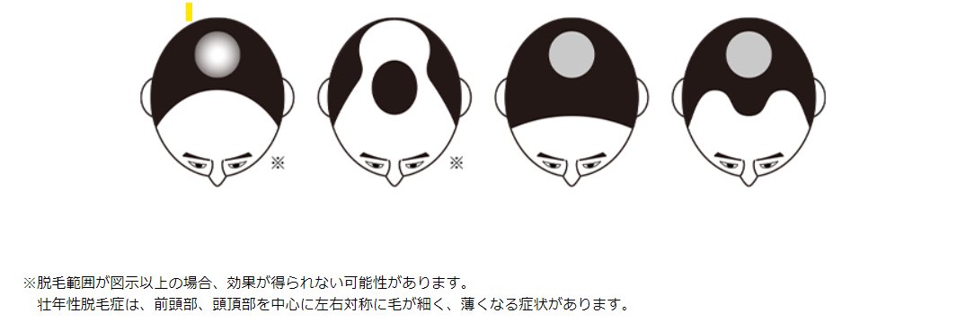 Regro_Official's tweet photo. ▼ミノキシジルとは
発毛に対する有用性が認められた成分です。
成分が毛包に作用することで、必要な細胞の増殖やタンパク質の合成を促進され頭皮から発毛します。
ミノキシジルは、下図のような症状の脱毛・薄毛に効果があります。
https://t.co/0VNpLSSqEO https://t.co/8mGe7s1xXT