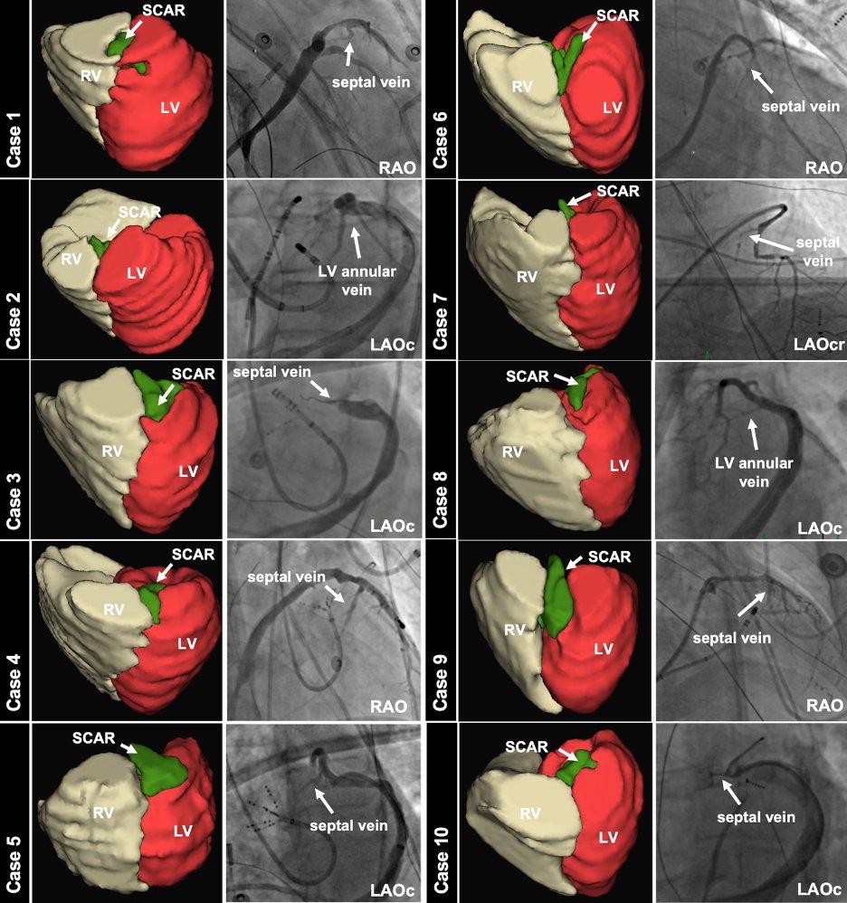 If venous ethanol ablation of LV summit PVC concerns you for possibly too big a lesion, check out our paper. sciencedirect.com/science/articl…