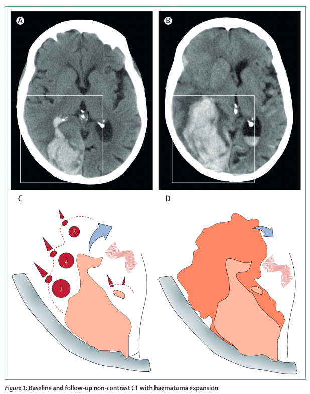 🩸🧠 What causes haematoma expansion? How we can better define it, find accurate predictors and ultimately prevent it in a timely fashion to improve outcomes? 🗞️Find out in our new Review paper @TheLancetNeuro Free PDF 👇👇 #neurotwitter #stroke #Neurology #Neurosurgery