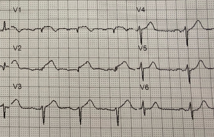 NavinKapur4's tweet image. #DTU Call is kicking off with a bang this week. Back to back trans-Atlantic anterior #STEMIs. One of the most innovative approaches to ensure optimal protocol execution. Grateful to all the PIs, CRC, and cath lab staff taking this trial on 24/7! Join the movement - R4 is next!