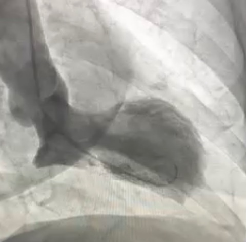 NavinKapur4's tweet image. #DTU Call is kicking off with a bang this week. Back to back trans-Atlantic anterior #STEMIs. One of the most innovative approaches to ensure optimal protocol execution. Grateful to all the PIs, CRC, and cath lab staff taking this trial on 24/7! Join the movement - R4 is next!