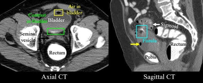 History and physical exam with pneumaturia or fecaluria are key for diagnosing colovesicular fistula. CT scan with PO or rectal contrast is the imaging modality of choice. #MedEd #FOAMed #FOAMrad #MedTwitter @RASACS radiologyspirit.blogspot.com/2010/07/divert…