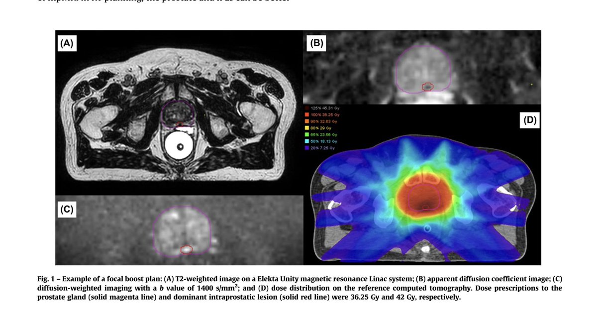 DrDarrenPoon's tweet photo. Hot-off the press ๐
MR-guided intra-prostatic lesion boost in EBRT for PCa : Systematic review & meta-analysis ๐ฅ
17 studies (n=1290)
5yr bDFS: 95%
Minimal G3 GI/GU toxicities
https://t.co/V4daFlFCys
@EurUrolOncol @alison_tree @AmarUKishan @KerkmeijerLinda @VedangMurthy https://t.co/R99n2Xp59p