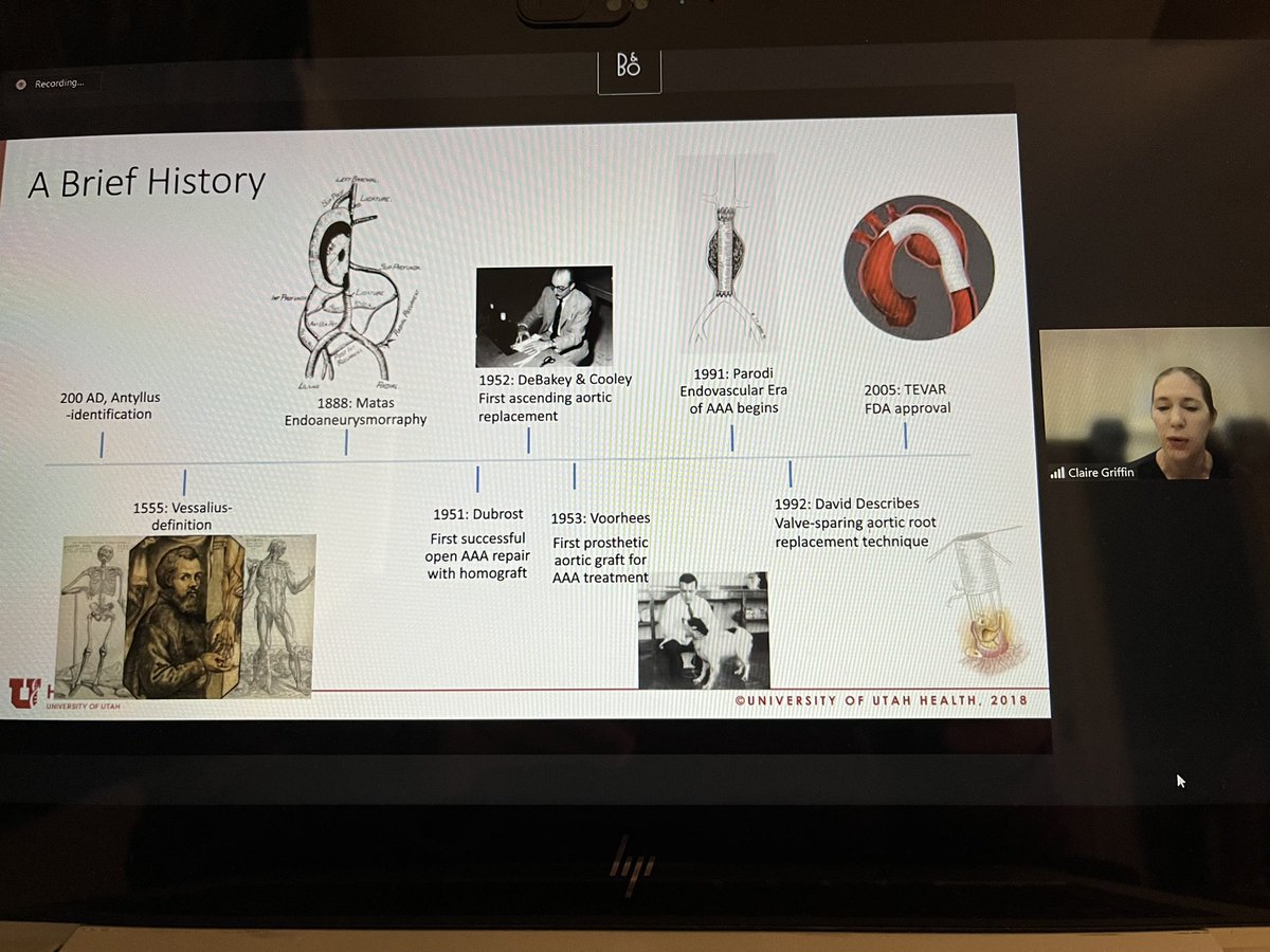 Angela Washenko, BSN, RN 🇺🇸🇺🇦 (@angelawashenko) on Twitter photo I learned so much about Aortic disease today from <a href="/JGlotzbachMD/">Jason P. Glotzbach, MD</a> & Claire Griffin, MD. The importance of a multidisciplinary effort->better outcomes. I really enjoy surgical history as well. ❤️❣️<a href="/camila_vargas/">Camila Vargas</a> <a href="/StavrosDrakos/">Stavros George Drakos</a> <a href="/UofUCTSurgery/">UofU CT Surgery</a> <a href="/UofUCV/">U of U Cardiovascular Medicine</a> <a href="/UofUVascular/">University of Utah Vascular Surgery</a> <a href="/JosefStehlik/">Josef Stehlik</a> I learned so much about Aortic disease today from <a href="/JGlotzbachMD/">Jason P. Glotzbach, MD</a> & Claire Griffin, MD. The importance of a multidisciplinary effort->better outcomes. I really enjoy surgical history as well. ❤️❣️<a href="/camila_vargas/">Camila Vargas</a> <a href="/StavrosDrakos/">Stavros George Drakos</a> <a href="/UofUCTSurgery/">UofU CT Surgery</a> <a href="/UofUCV/">U of U Cardiovascular Medicine</a> <a href="/UofUVascular/">University of Utah Vascular Surgery</a> <a href="/JosefStehlik/">Josef Stehlik</a>