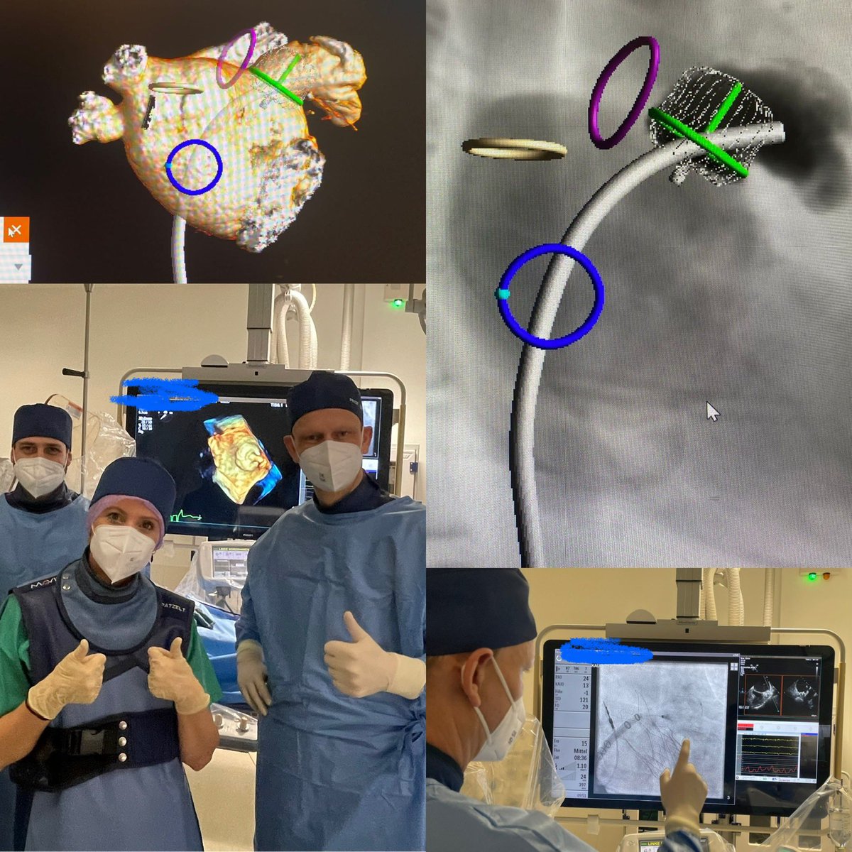 IngoEitel's tweet photo. First #LAAC interventional #cardiology case in Europe using the WATCHMAN TruePlan #CT software for optimized pre-procedural planning, sizing and Watchman FLX positioning.
@circlecvi @BSC_EU_Heart @KardiologieHH @docsaw @vonBardelebenRS @KardiologieHH @t_stiermaier @mgwfriedrich https://t.co/8UZwTuxxP5