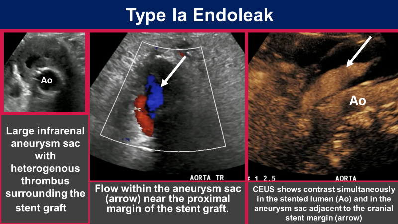 samrad77's tweet photo. Type I endoleak occurs due to insufficient attachment of the stent graft limb to the native arterial wall and may be proximal (type IA) or distal (type IB), with resultant sac expansion from antegrade blood flow.

#RGPhx
10/15 https://t.co/rjbE0iJqvn