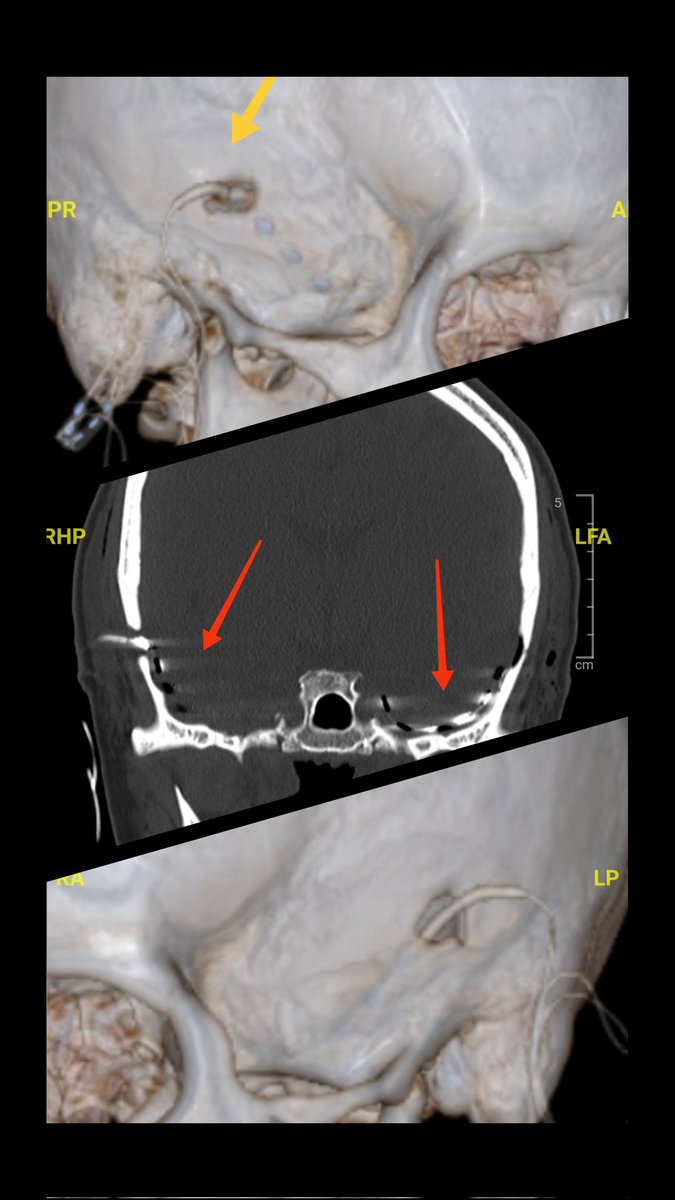 Dr Christian Cantillano M. (@drcantillano) on Twitter photo Monitoreo invasivo para epilepsia temporal bilateral refractaria. Optimizando los poquísimos recursos del sector público para pacientes vulnerables. Medicina de primer mundo para nuestros paciente fonasa. <a href="/UribeChile/">DrUribeEpilepsiaChile</a> <a href="/ministeriosalud/">Ministerio de Salud</a> <a href="/recabaez/">Alexander Recabarren</a> <a href="/ximenaguilera/">Ximena Aguilera</a> Monitoreo invasivo para epilepsia temporal bilateral refractaria. Optimizando los poquísimos recursos del sector público para pacientes vulnerables. Medicina de primer mundo para nuestros paciente fonasa. <a href="/UribeChile/">DrUribeEpilepsiaChile</a> <a href="/ministeriosalud/">Ministerio de Salud</a> <a href="/recabaez/">Alexander Recabarren</a> <a href="/ximenaguilera/">Ximena Aguilera</a>