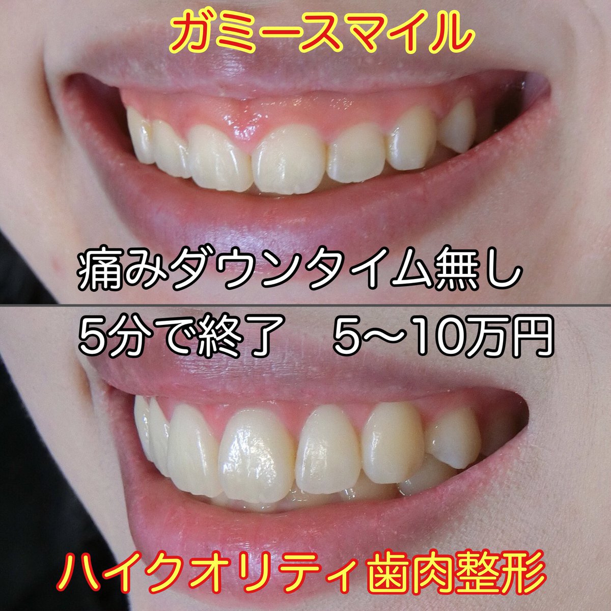 未使用 SmilePro スマイルプロ インビザライン加速矯正装置-