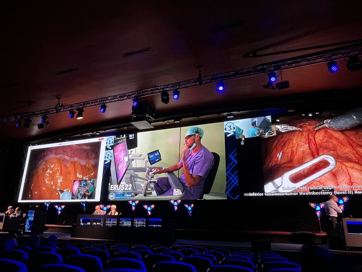#ERUS22 day 2 live surgeries kick-off with @Ruben_De_Groote roboti lc pyeloplasty, @AlbertoBreda1 RAPN, Dr. Zhang RARN with caval thrombus III/IV