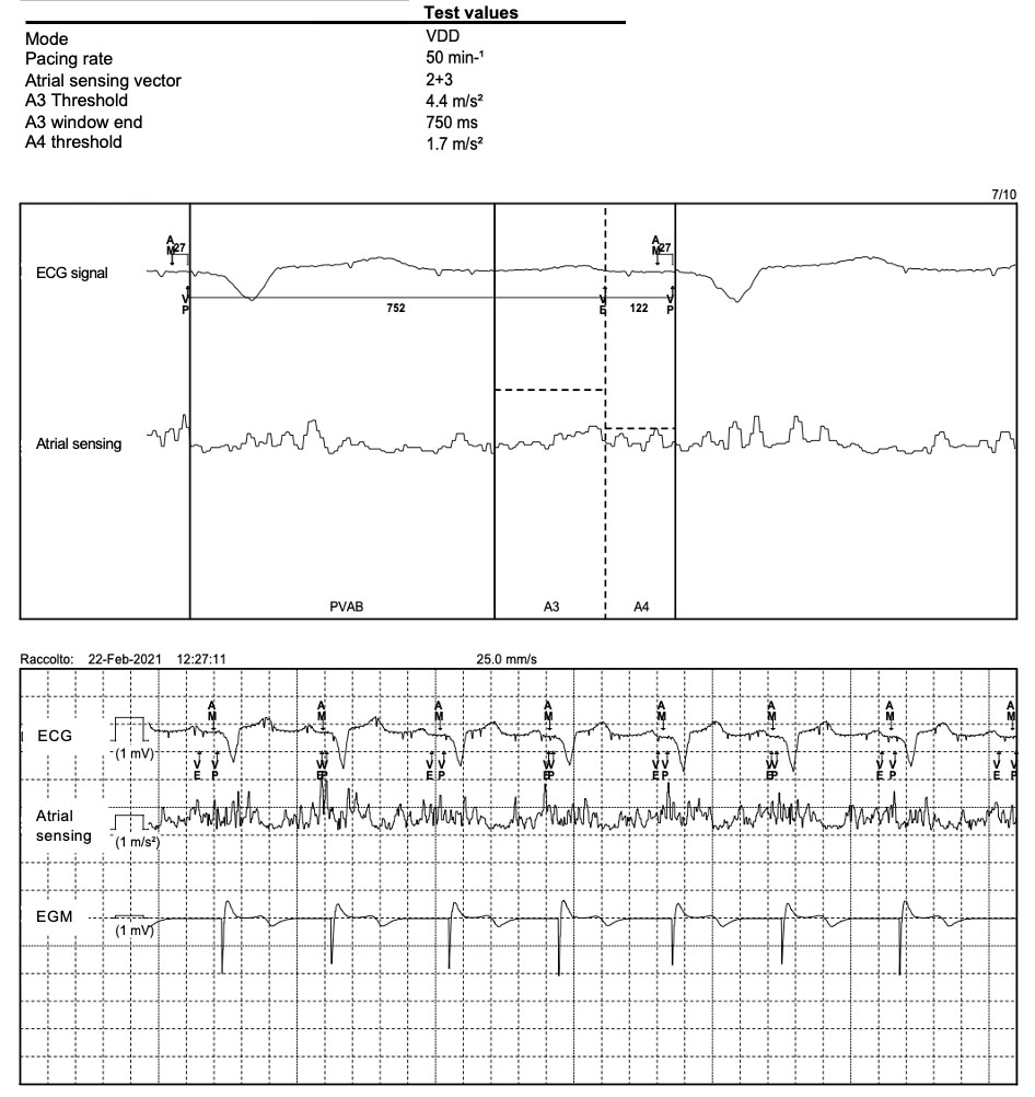 RCMjournal's tweet photo. #RCM - Vol. 22 No. 2
#Callforread
💝Review - Atrioventricular synchronous leadless pacemaker: state of art and broadened indications
@GMitacchione @marcoschiavone5 @gasperettimd 

#leadless #pacemaker #LLPM #atrioventricular #transvenous

Full text:
https://t.co/UVtwHQ4qM3 https://t.co/o1hEWbyw8D