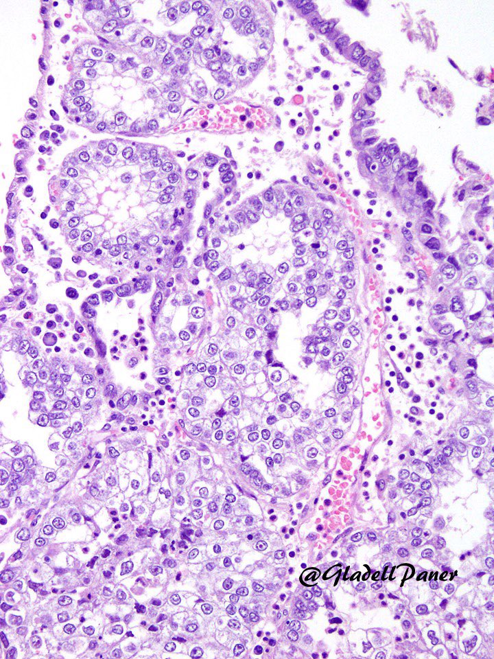 Nice example of the rare Clear cell (Mullerian) adenocarcinoma primarily arising from the urinary #bladder. #GUPath