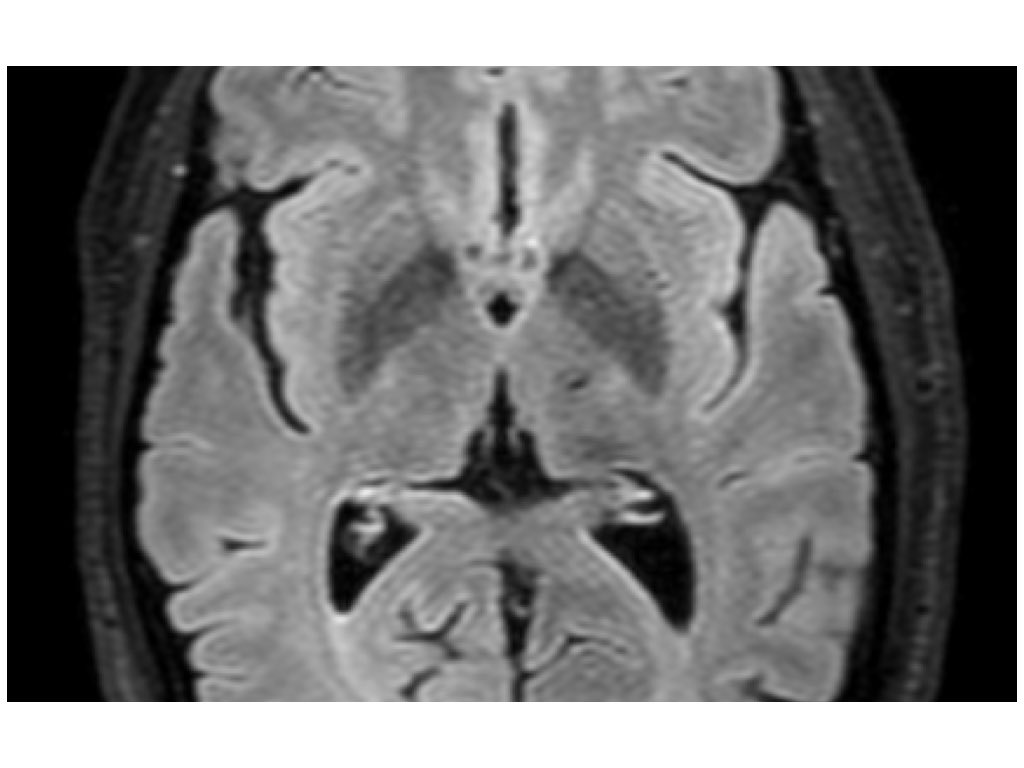 gferpaj's tweet photo. Hoy, un año después de lograr la certificación para el tratamiento con #HIFU, en Santiago hemos realizado la primera talamatomía bilateral en #temblor refractario en un Hospital público de España. Equipazo! @neuroimagen @Pauci_Pau @LuisMontes68 @santiagosergas @josemaoscar https://t.co/ocFNgd2lC6