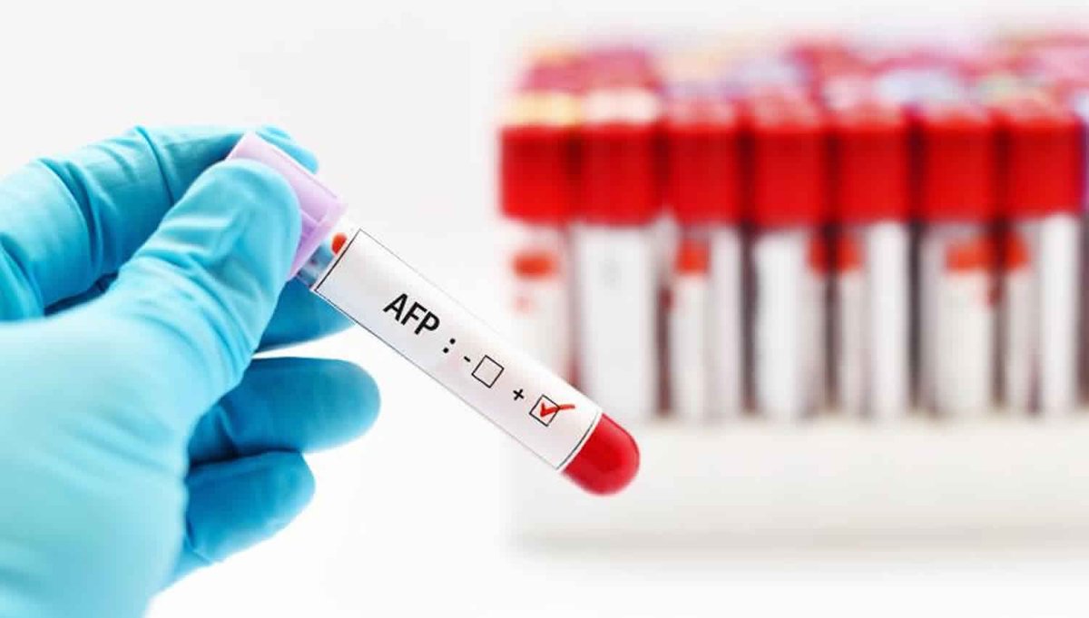 Manideep_IARC's tweet photo. The alpha-#fetoprotein (AFP) or #foetal alpha globulin is thought to operate in the #foetus in an identical role to that of serum albumin postnatally.

For More : https://t.co/4Ad2rwVHB4

#Hospitals #Clinics #Cancer #pancreaticcancer #healthcare https://t.co/Vilc0xbQ6G