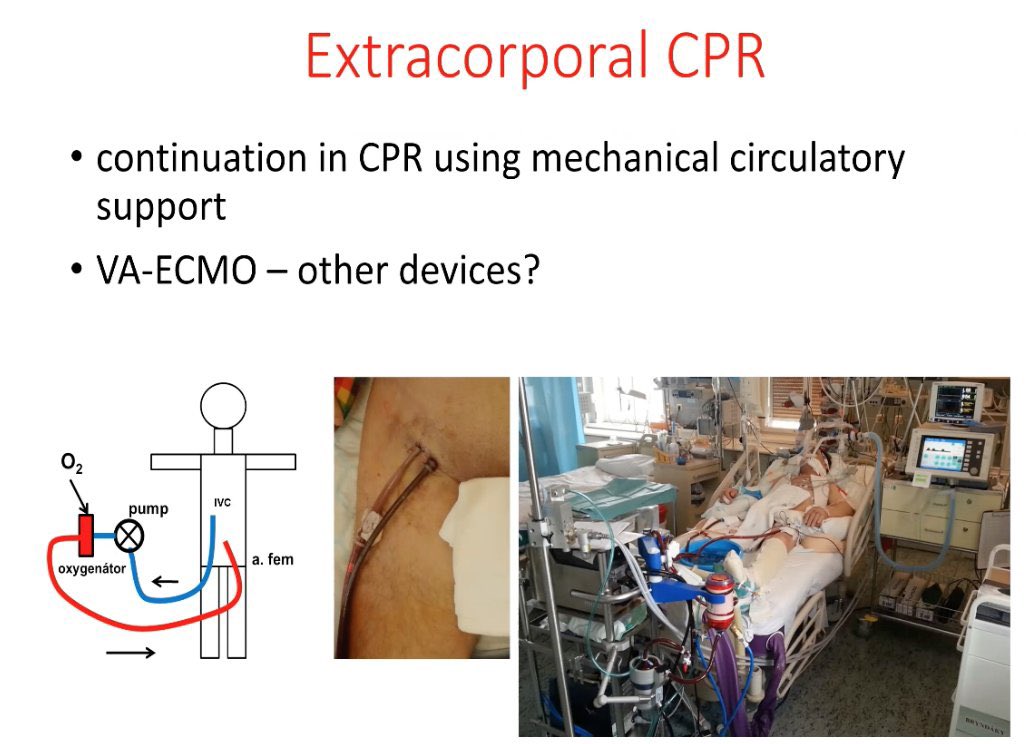 FOAMecmo's tweet photo. 🚑 + 🏥 Refractory CA? NOT #ECPR alone, but global approach including #ECMO starting w preH system may improve #OHCA outcomes! Technology + first RCTs data available, still need to better define candidates/optimize logistics/replicate in multicenter RCT
@jan_belohlavek #PraguECPR https://t.co/gweFPdY7DI