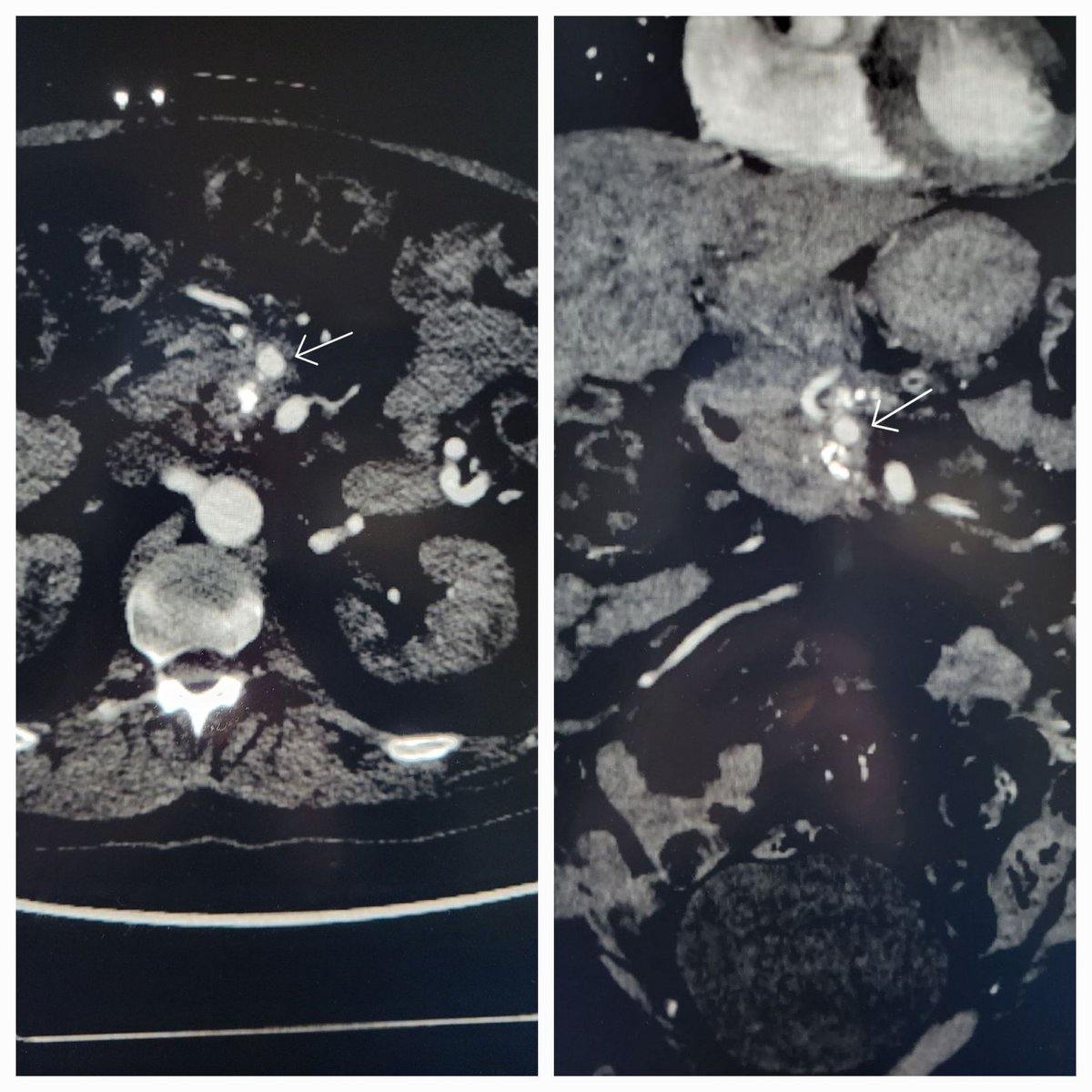 TempleRADs's tweet photo. Patient w/ GI bleed and GDA pseudoaneurysm. Why must the arteries be so tortuous/torturous? After much persistence, PSA sac coiled along w/ "front door." (Unable to get distal). Nice case @MarkEdelsteinIR Dr. Niman! Great read @k_maruti Dr. Danial! @TempleRadRes @SIR_ECS @SIRRFS https://t.co/BaNf37VVMG