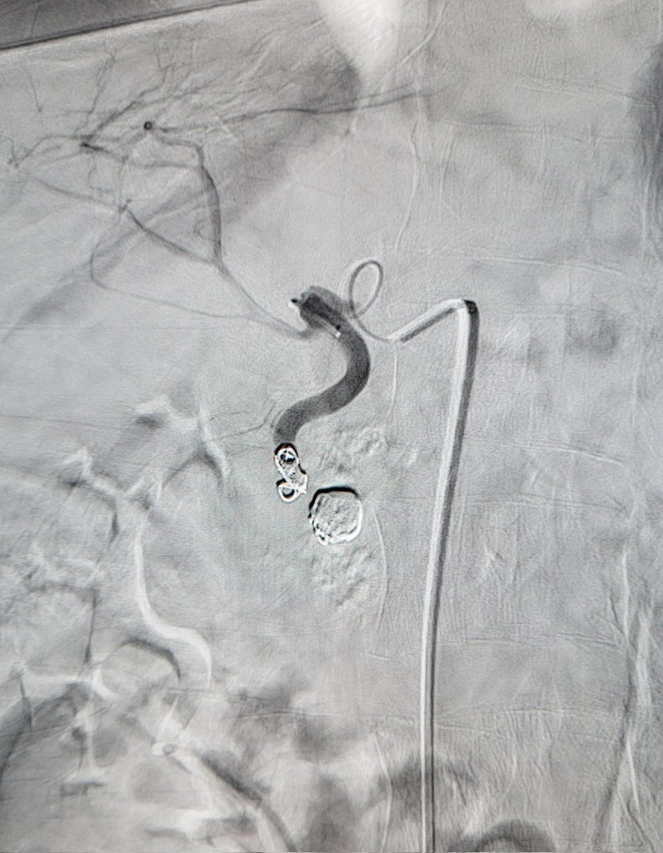 TempleRADs's tweet photo. Patient w/ GI bleed and GDA pseudoaneurysm. Why must the arteries be so tortuous/torturous? After much persistence, PSA sac coiled along w/ "front door." (Unable to get distal). Nice case @MarkEdelsteinIR Dr. Niman! Great read @k_maruti Dr. Danial! @TempleRadRes @SIR_ECS @SIRRFS https://t.co/BaNf37VVMG