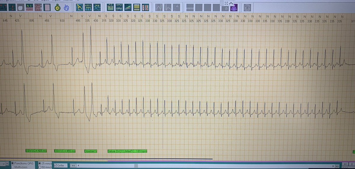 ecgrhythms on Twitter "RT oussdaou 70 yo male patient, Holter