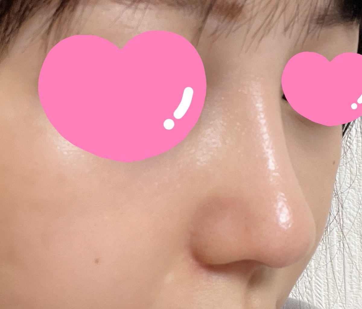 a0x_j's tweet photo. @gamipsjapan  ガミ整形外科　GAMI整形外科　　鼻フルレポ　2ヶ月
腫れ感はほぼないです。痛さや赤みもなくなり、若干傷跡はあるもののナチュラルメイクで隠せるくらいです。
1ヶ月までと比べると鼻先の出た感じがなくなって馴染んできてとてもいい感じです。 https://t.co/glyQ9UqpVQ