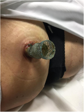 videogie's tweet photo. Check out a recently published case report by Sabrina Torrisi et al, "Transabdominal self-expandable metal stent placement as a rescue therapy for drainage of walled-off necrosis." https://t.co/50huIkY1PJ https://t.co/CFfUJhHyn0