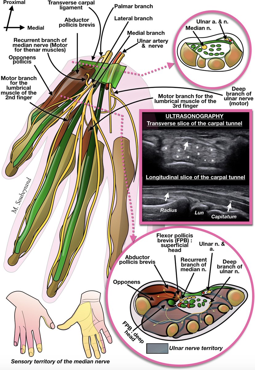Dr. OMID BANDARCHI (@obandarchi) on Twitter photo I think that's what you're asking👍Fantastic demonstration of detailed anatomy including sonographic anatomy of Median nerve👏👏: 
doi.org/10.1016/j.hans…
1. In the hand(shown here)
2. At the elbow and forearm(comment 1)
3. Between the axillary fossa and the elbow(comment 2) I think that's what you're asking👍Fantastic demonstration of detailed anatomy including sonographic anatomy of Median nerve👏👏: 
doi.org/10.1016/j.hans…
1. In the hand(shown here)
2. At the elbow and forearm(comment 1)
3. Between the axillary fossa and the elbow(comment 2)