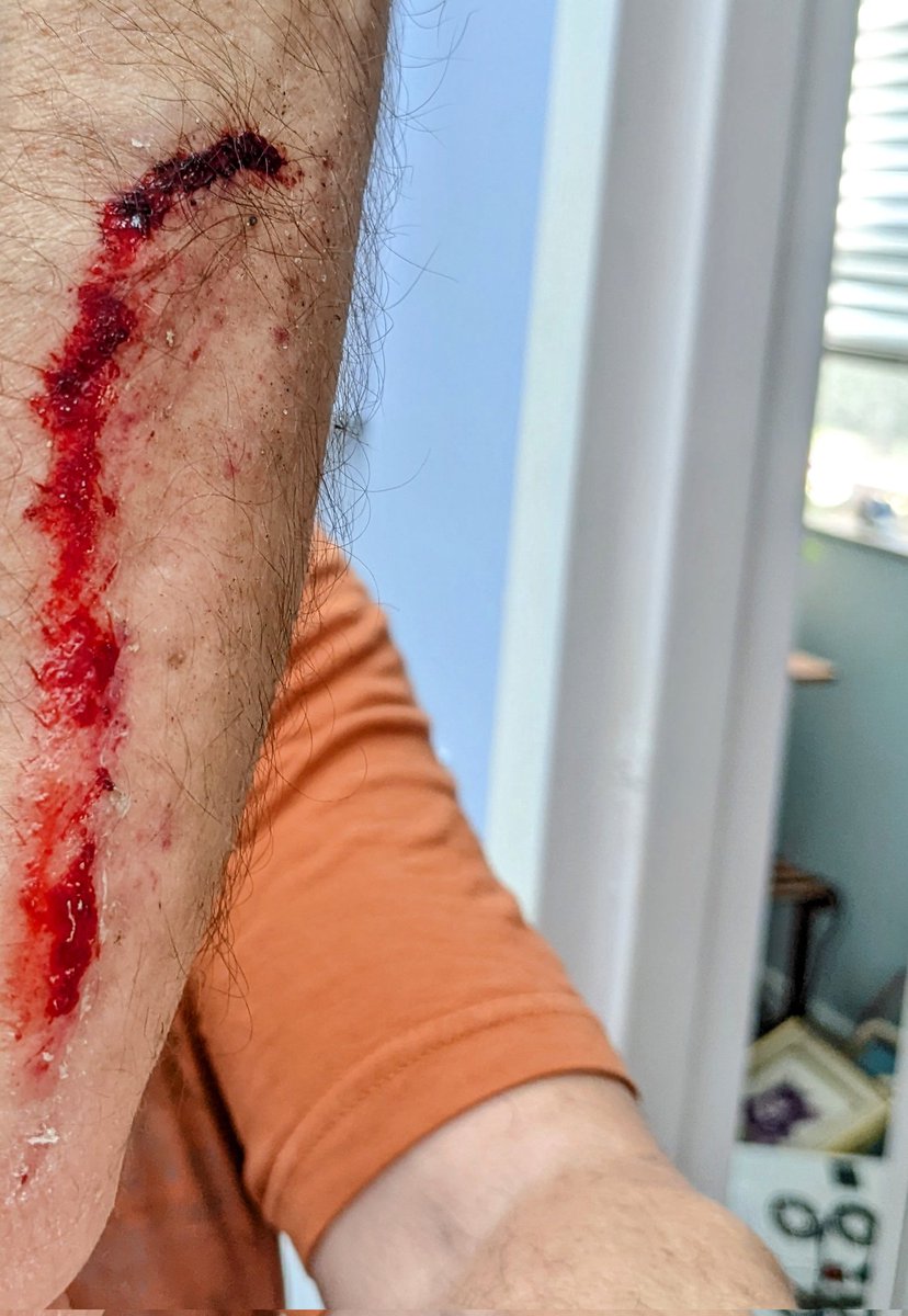 ismellskunk's tweet photo. Fell riding my bike https://t.co/3xQ0VdIrvH