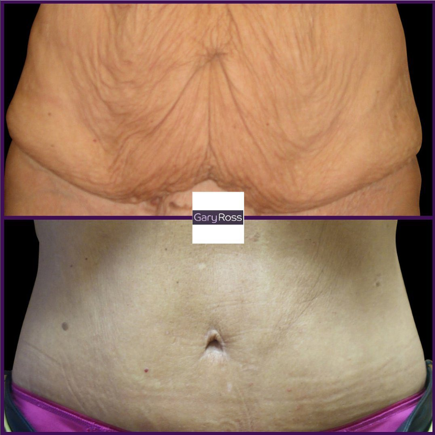 ukaesthetic's tweet photo. If you would like to find out more about body-lifts visit this link https://t.co/Lfdo9Bnlvj #bodylift #upperbodylift #lowerbodylift #bodycontouring #bodyrejuvenation #abdominoplasty #abdominalrejuvenation #cosmeticsurgeon #plasticsurgeon #garyross https://t.co/RsIZjstnpu